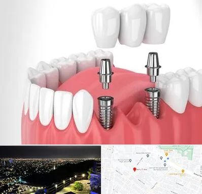 کاشت دندان در هفت تیر مشهد