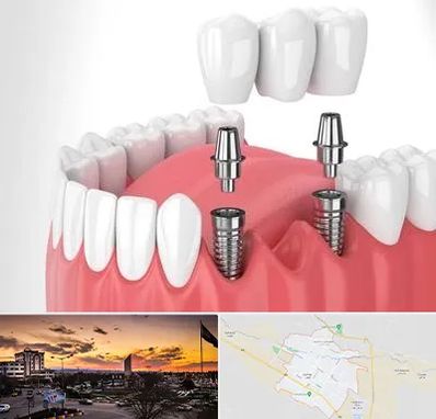 کاشت دندان در قوچان