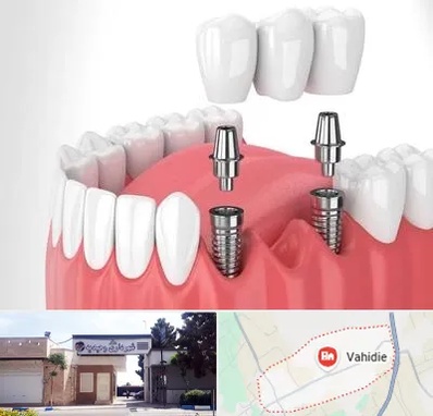 کاشت دندان در وحیدیه شهریار