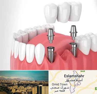 کاشت دندان در اسلامشهر
