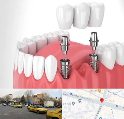 کاشت دندان در شهناز تبریز