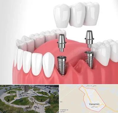 کاشت دندان در ورامین