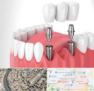 کاشت دندان در شهرک غرب مشهد