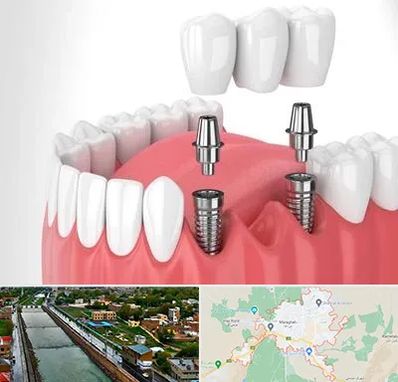 کاشت دندان در مراغه