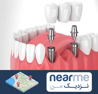 کاشت دندان در نزدیک من