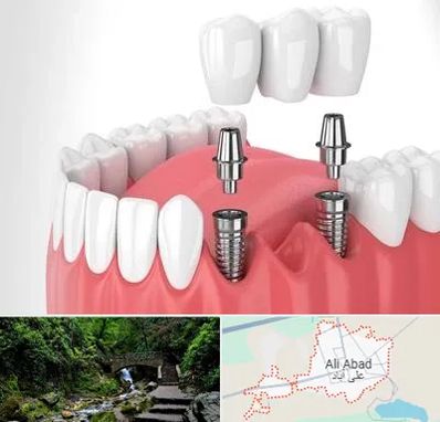 کاشت دندان در علی‌ آباد کتول