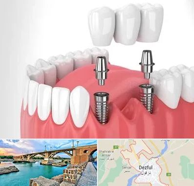 کاشت دندان در دزفول