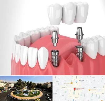 کاشت دندان در هفت حوض