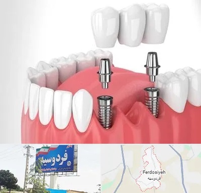 کاشت دندان در فردوسیه شهریار