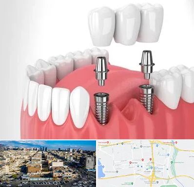 کاشت دندان در شهرک راه آهن