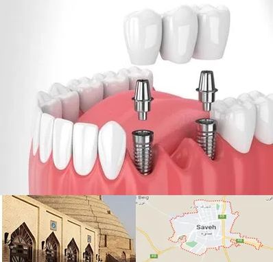 کاشت دندان در ساوه