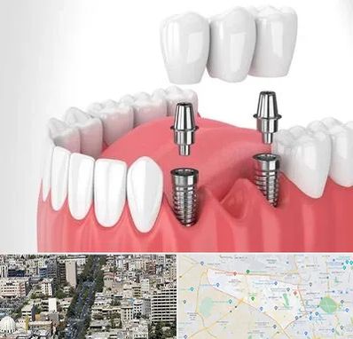 کاشت دندان در منطقه 18 تهران
