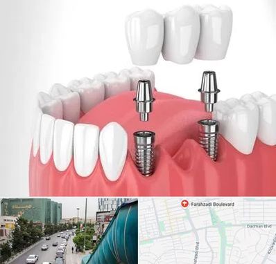 کاشت دندان در بلوار فرحزادی