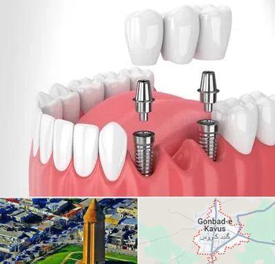 کاشت دندان در گنبد کاووس