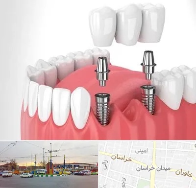 کاشت دندان در میدان خراسان
