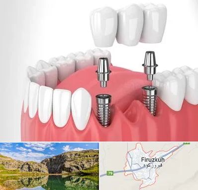 کاشت دندان در فیروزکوه