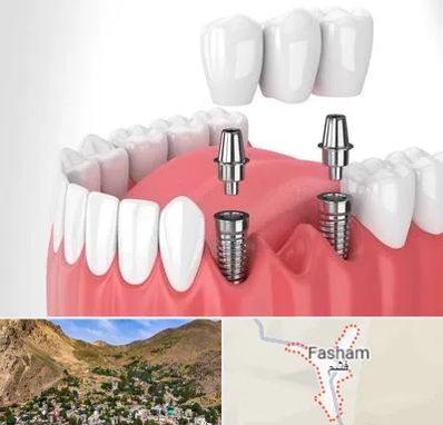 کاشت دندان در فشم