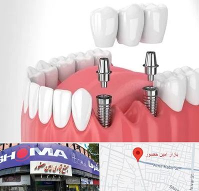 کاشت دندان در امین حضور