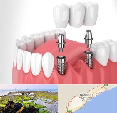 کاشت دندان در بندرلنگه