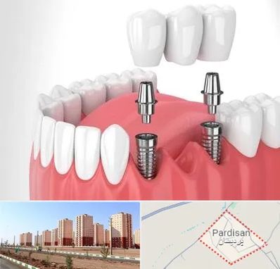 کاشت دندان در پردیسان قم