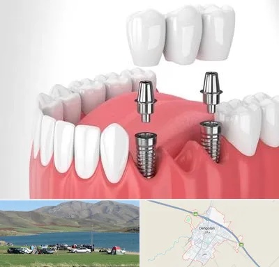 کاشت دندان در دهگلان
