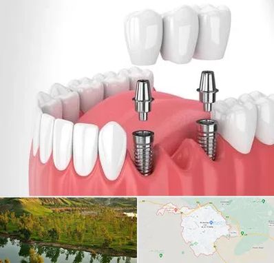 کاشت دندان در بهبهان