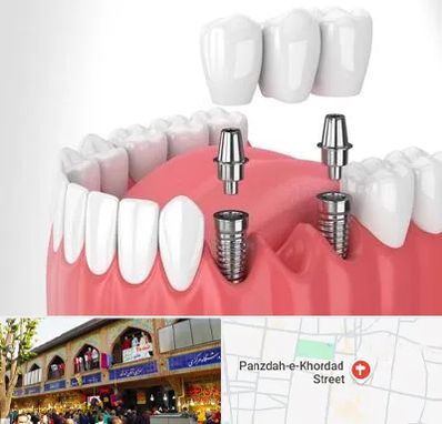 کاشت دندان در 15 خرداد