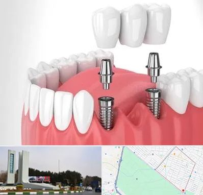 کاشت دندان در بلوار فلسیطین مشهد