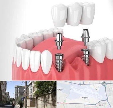 کاشت دندان در مهرآباد