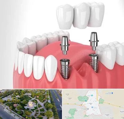 کاشت دندان در کاشمر