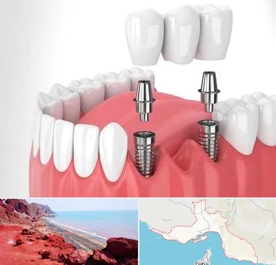 کاشت دندان در هرمزگان