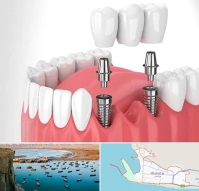 کاشت دندان در چابهار
