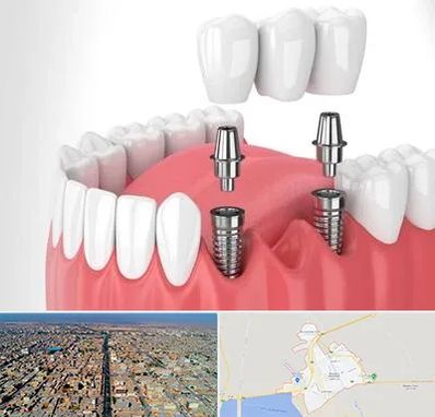کاشت دندان در بندر ماهشهر