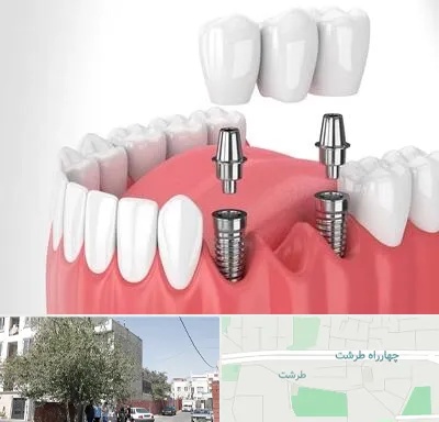 کاشت دندان در طرشت