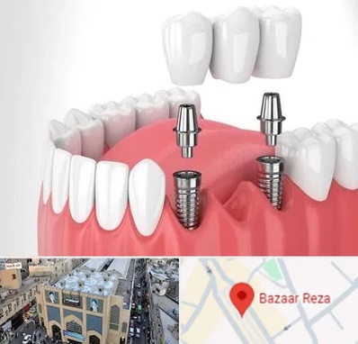 کاشت دندان در بازار رضا مشهد
