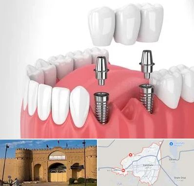کاشت دندان در ایرانشهر