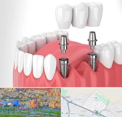 کاشت دندان در رشدیه تبریز