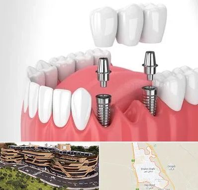 کاشت دندان در شاهین شهر