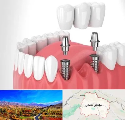 کاشت دندان در خراسان شمالی
