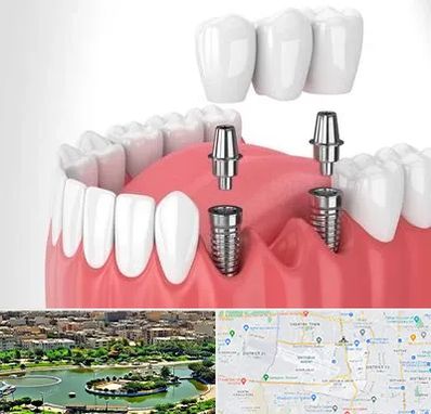 کاشت دندان در منطقه 9 تهران