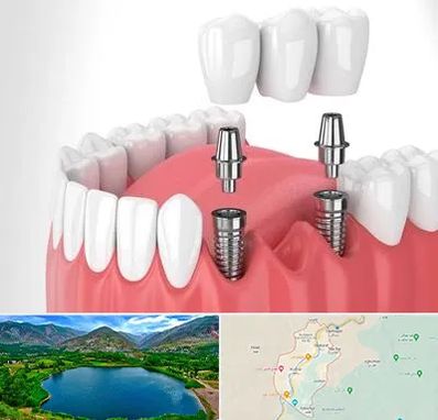 کاشت دندان در رودبار