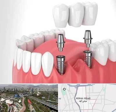 کاشت دندان در عباس آباد تهران