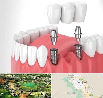 کاشت دندان در بروجرد