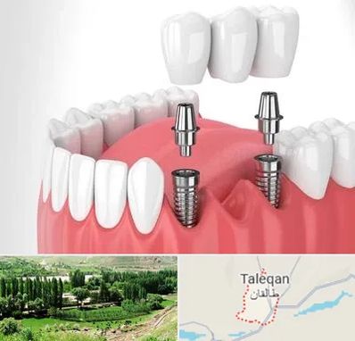 کاشت دندان در طالقان