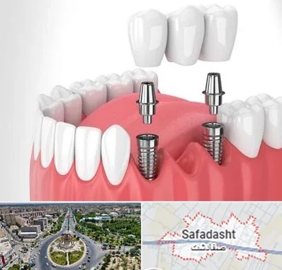 کاشت دندان در صفادشت