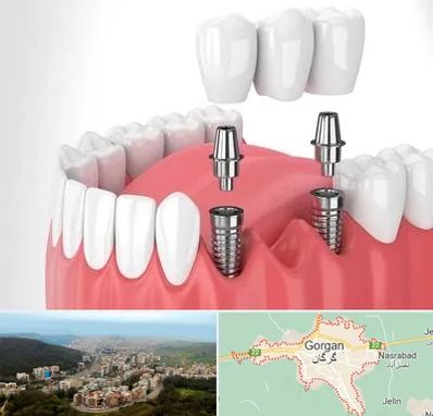 کاشت دندان در گرگان