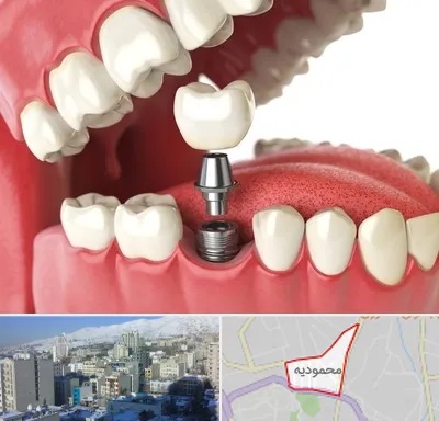 متخصص پروتز دندان در محمودیه