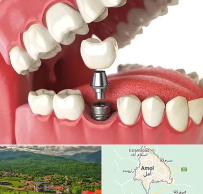 متخصص پروتز دندان در آمل