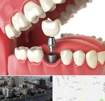 متخصص پروتز دندان در زرتشت