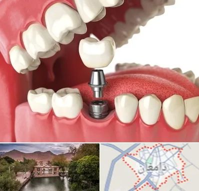 متخصص پروتز دندان در دامغان